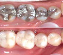 Couronnes dentaire avant et après
